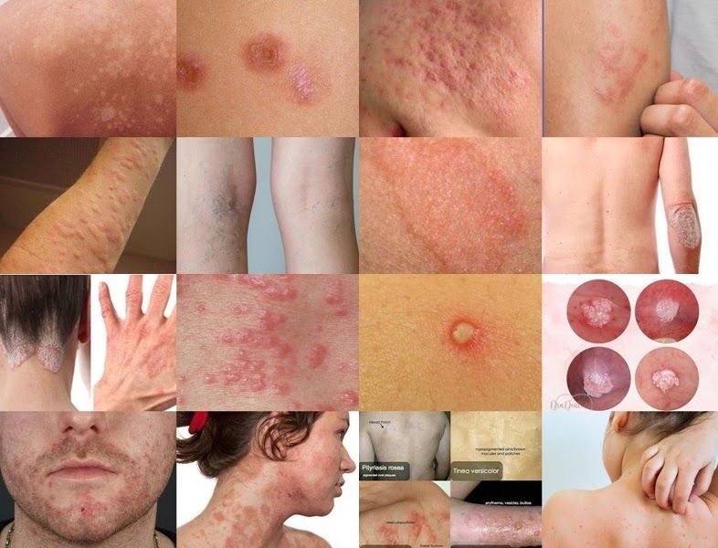 त्वचा रोग उपचार